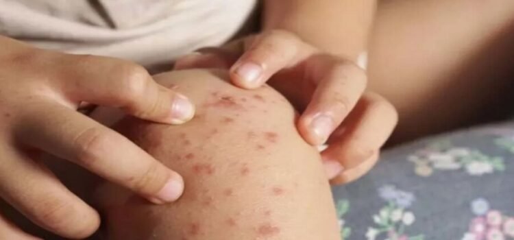 Baja California reporta 231 casos del virus Coxsackie Baja California reporta 231 casos del virus Coxsackie