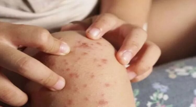 Baja California reporta 231 casos del virus Coxsackie